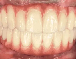 Full Arch treatment Options